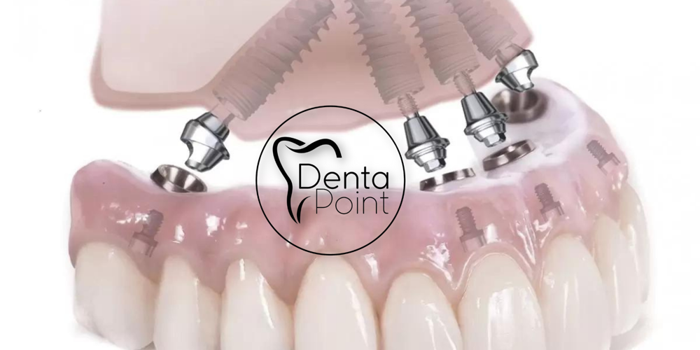 DentaPoint All on 4 İmplant