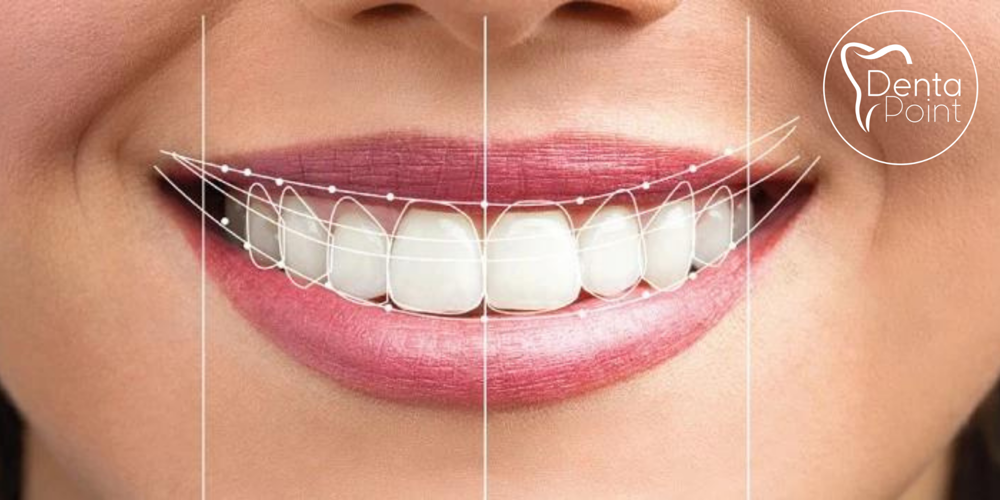 DentaPoint Hollywood Smile