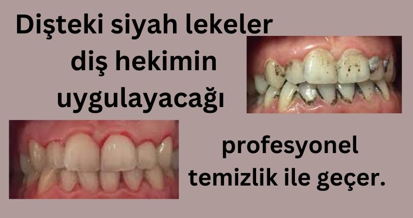 Dişteki Siyah Lekeler Nasıl Geçer? İzmir